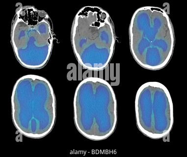 CT-Scan-Bilder aus ein 67 Jahre alter Mann mit schweren ein Hydrozephalus Stockfoto