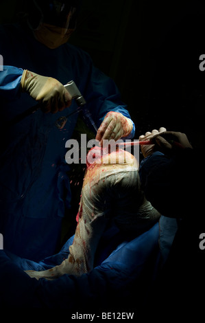 Ein Patient erfährt Kniegelenkersatz-Operationen in einem Krankenhaus West Midlands, nachdem er mit irreparablen Schäden diagnostiziert Stockfoto