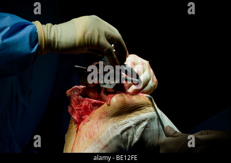 Ein Patient erfährt Kniegelenkersatz-Operationen in einem Krankenhaus West Midlands, nachdem er mit irreparablen Schäden diagnostiziert Stockfoto