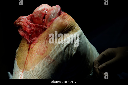 Ein Patient erfährt Kniegelenkersatz-Operationen in einem Krankenhaus West Midlands, nachdem er mit irreparablen Schäden diagnostiziert Stockfoto