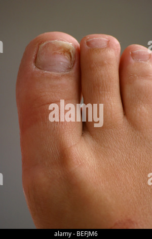 Tinea Pedis eine Pilzinfektion, die Auswirkungen auf den Fuß ...