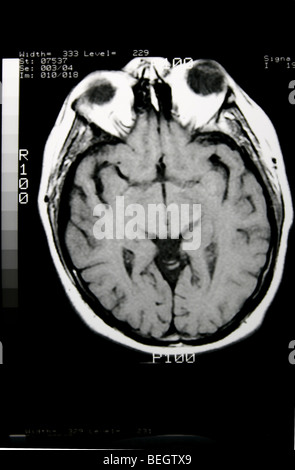 MRI scan des Gehirn des Patienten mit und ohne Kontrastmittel Stockfoto