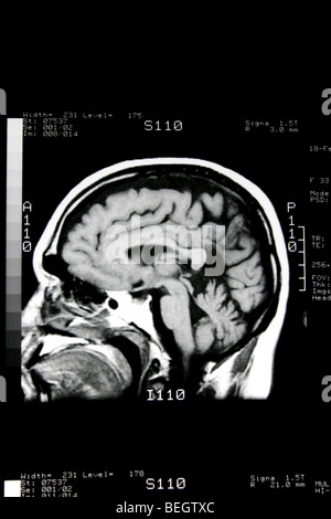 MRI scan des Gehirn des Patienten mit und ohne Kontrastmittel Stockfoto