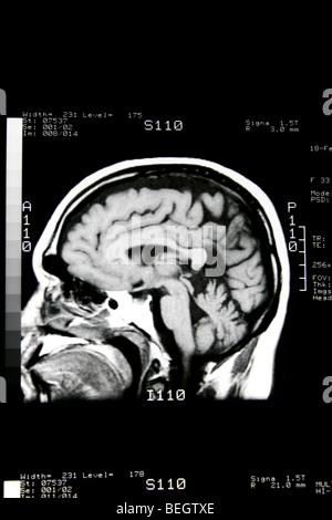 MRI scan des Gehirn des Patienten mit und ohne Kontrastmittel Stockfoto