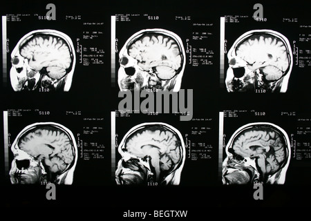 MRI scan des Gehirn des Patienten mit und ohne Kontrastmittel Stockfoto