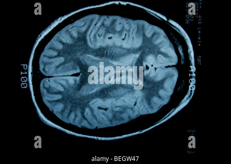 MRI scan des Gehirn des Patienten mit und ohne Kontrastmittel Stockfoto