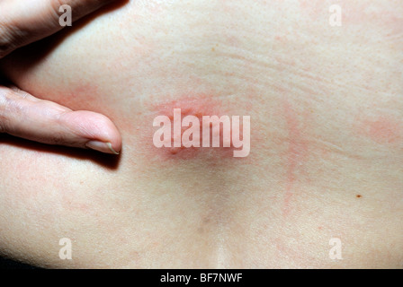 Ein Patch von Gürtelrose Hautausschlag. Vesikel. Herpes Zoster. Stockfoto