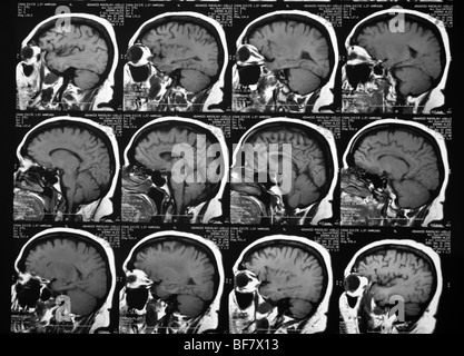 CT-Scans des menschlichen Kopfes Stockfoto