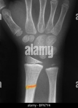 eingefärbte Röntgenbild zeigt eine Fraktur des distalen radius Stockfoto