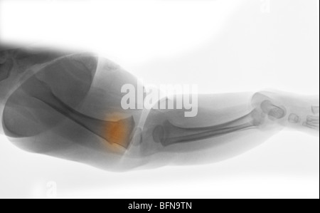 X-ray das Bein zeigt eine Femur Fraktur in ein 8 Monate altes Mädchen, das war das Opfer der Verdacht auf Kindesmisshandlung. Stockfoto