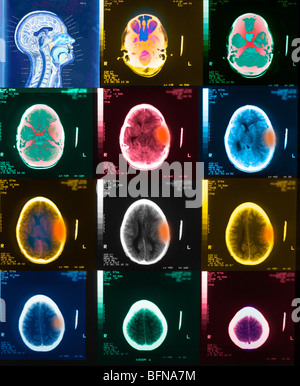 CT-Scan des Gehirns 10 jährige junge epidurales Hämatom von Trauma.  Die Ventrikel sind komprimiert und seitlich versetzt Stockfoto
