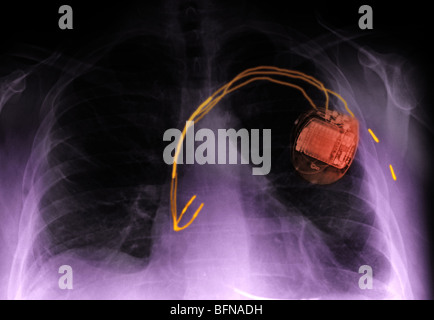Röntgen-Thorax zeigt einen Herzschrittmacher Stockfoto