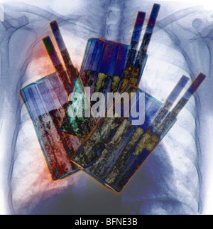 Zigaretten, die primäre Ursache von Lungenkrebs, eine Brust Röntgen zeigt Lungenkrebs überlagert Stockfoto