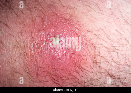 Methicillin-resistenten Staph Aureus Hautinfektion Stockfoto, Bild: 6340010 - Alamy