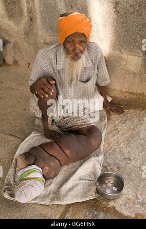 Ein indischer Mann Elephantiasis leiden hat einen aufgeblähten Bein. Er lebt vom betteln. Stockfoto