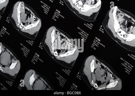 MRI Scan Nahaufnahme. Neigen Sie Ansicht. Stockfoto