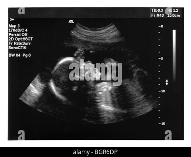 Lizenz verfügbar unter MaximImages.com - Ultraschall-Bildgebung eines Babys. Fünf Monate alter Fetus. Stockfoto