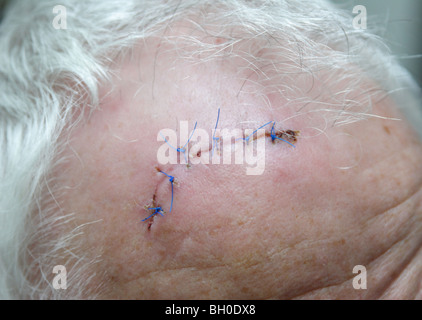Chirurgische Fäden in eine Wunde am Kopf. Stockfoto