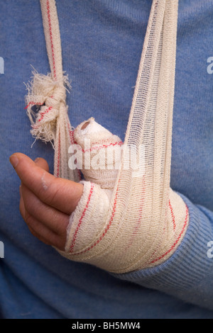 Eine Person mit einem gebrochenen Daumen trägt eine Besetzung, ihre Hand in einer Schlinge. Stockfoto