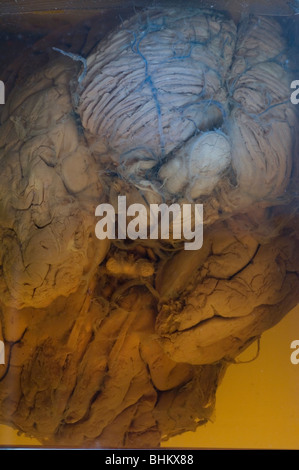 Menschliche Gehirn einbalsamiert im Weckglas Stockfoto