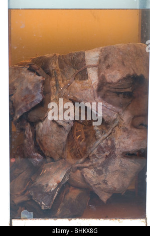 Nahaufnahme eines toten Mannes Kopf bewahrt im Weckglas Stockfoto