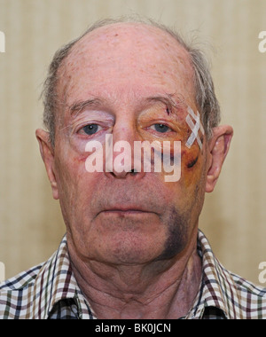 Gesichtsbehandlung Wunden, Prellungen und Verletzungen auf Elderley 76 Jahre alten weißen Mann nach überfallen von Jugendlichen in Oxfordshire, England Stockfoto