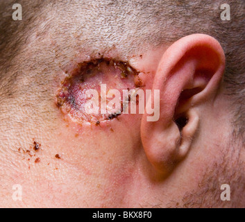 Hautkrebs Stockfoto
