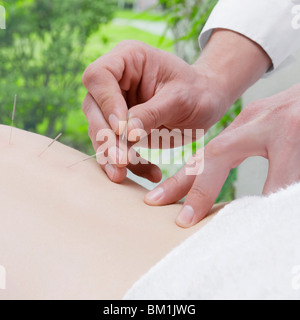 Akupunktur Nadeln auf eine Person anwenden Stockfoto