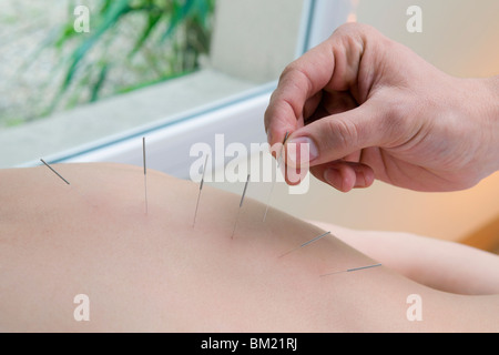 Akupunktur Nadeln auf eine Person anwenden Stockfoto