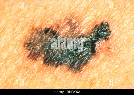Melanom (Hautkrebs) mit Färbung von verschiedenen Schattierungen von Braun, schwarz oder tan. Stockfoto