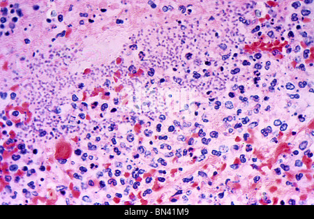 Leichte Mikrophotographie zeigt die histologischen Veränderungen im Gewebe der Milz im Falle eines schwerwiegenden menschlichen Pest; Mag 400 X Stockfoto