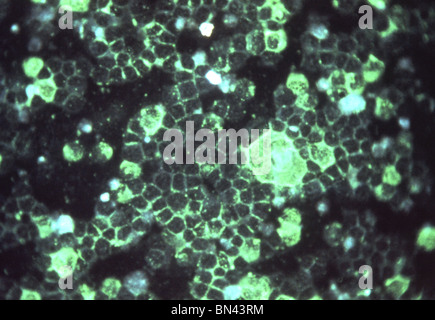 Mikrophotographie zeigt respiratory syncytial Virus (RSV) mit indirekten Immunfluoreszenz-Technik Stockfoto