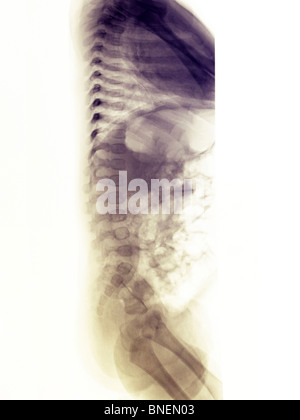 Röntgenaufnahme der Wirbelsäule ein 3 Monate altes Mädchen Stockfoto