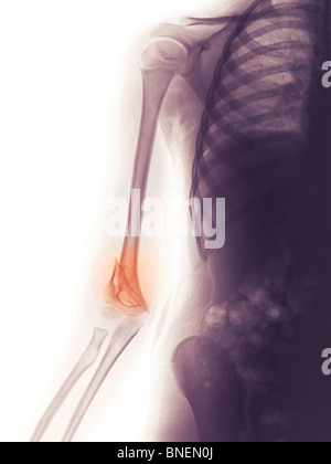 Röntgenbild eines gebrochenen distalen humerus Stockfoto