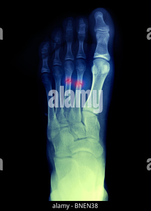 Fuß Röntgen zeigt 2. und 3. Mittelfußknochen gebrochen Stockfoto