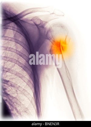 Röntgen der Schulter zeigt gebrochenen Oberarmknochen. Stockfoto