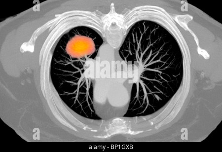 CT-Scan axialer Abschnitt zeigt einen Krebs in der rechten Lunge eine 77 Jahre alte Frau Stockfoto