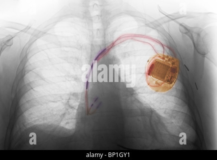 Röntgen-Thorax zeigt eine implantierte Herzschrittmacher Stockfoto