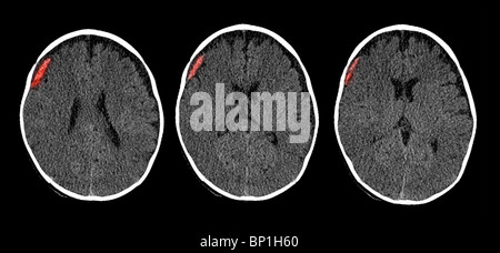 CT-Scan des Gehirns ein 6 Monate altes Kind zeigt eine subdurale Hämatom Stockfoto