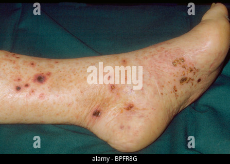 Das Bein und Fuß eines Patienten mit einer Entzündung der Blutgefäße. Stockfoto