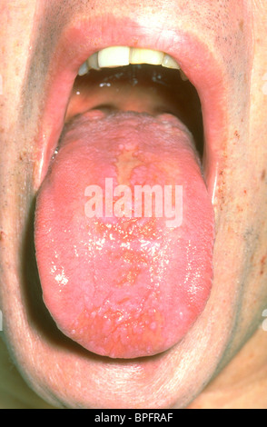 Die Zunge eines Patienten mit einer Entzündung der Blutgefäße. Stockfoto