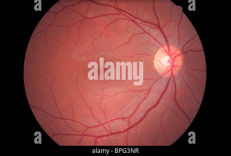 Augenhintergrundes Kamerabild der Netzhaut eines normalen Auges, zeigt die Verteilung der retinalen Venen & Arterien. Stockfoto