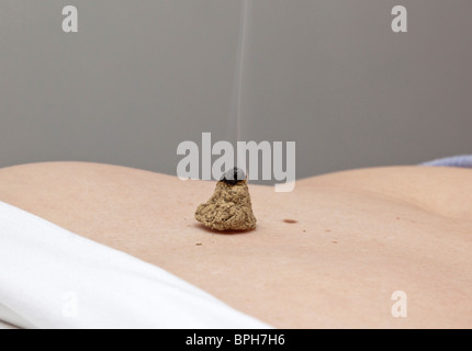 Patienten, die durch Erhitzen mit Moxibustion behandelt Stockfoto