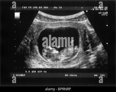 Geburtshilfliche Sonographie der dritte Monat Fötus Stockfoto