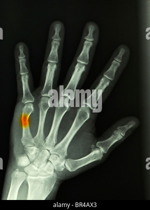 x-ray eine 57 Jahre alte Mann zeigt eine 5. Mittelhandknochen (Boxer) Fraktur erlitten von Stanzen eine Wand die Hand Stockfoto