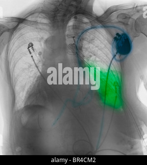 Röntgen-Thorax zeigt einen Herzschrittmacher und einer Fläche von Lungenentzündung in der linken Unterlappen der 78 Jahre alte Frau Stockfoto