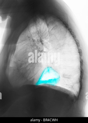 x-ray zeigt eine Hiatushernie in einer 82 Jahre alten person Stockfoto