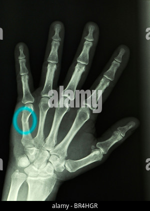 x-ray eine 57 Jahre alte Mann zeigt eine 5. Mittelhandknochen (Boxer) Fraktur erlitten von Stanzen eine Wand die Hand Stockfoto