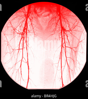 normale Aorta Angiogramm der Femoral Arterien an den Beinen Stockfoto