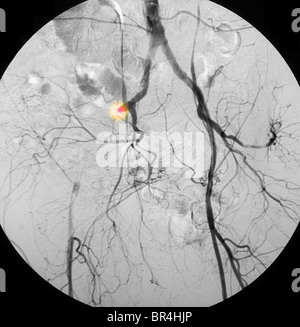 Angiogramm einer 68 jährige Frau mit schweren Stenose ihr direkt externe Beckenkamm Arterie Stockfoto